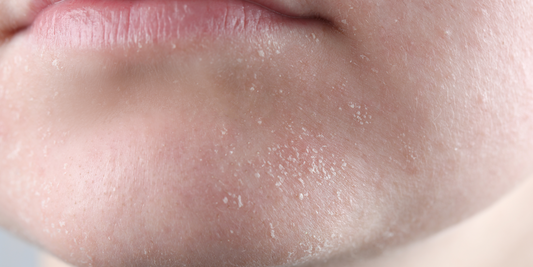 How to Support Your Skin Barrier