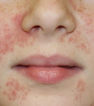 Cheat Sheet - Perioral Dermatitis or 'those red annoying spots that won't go away'