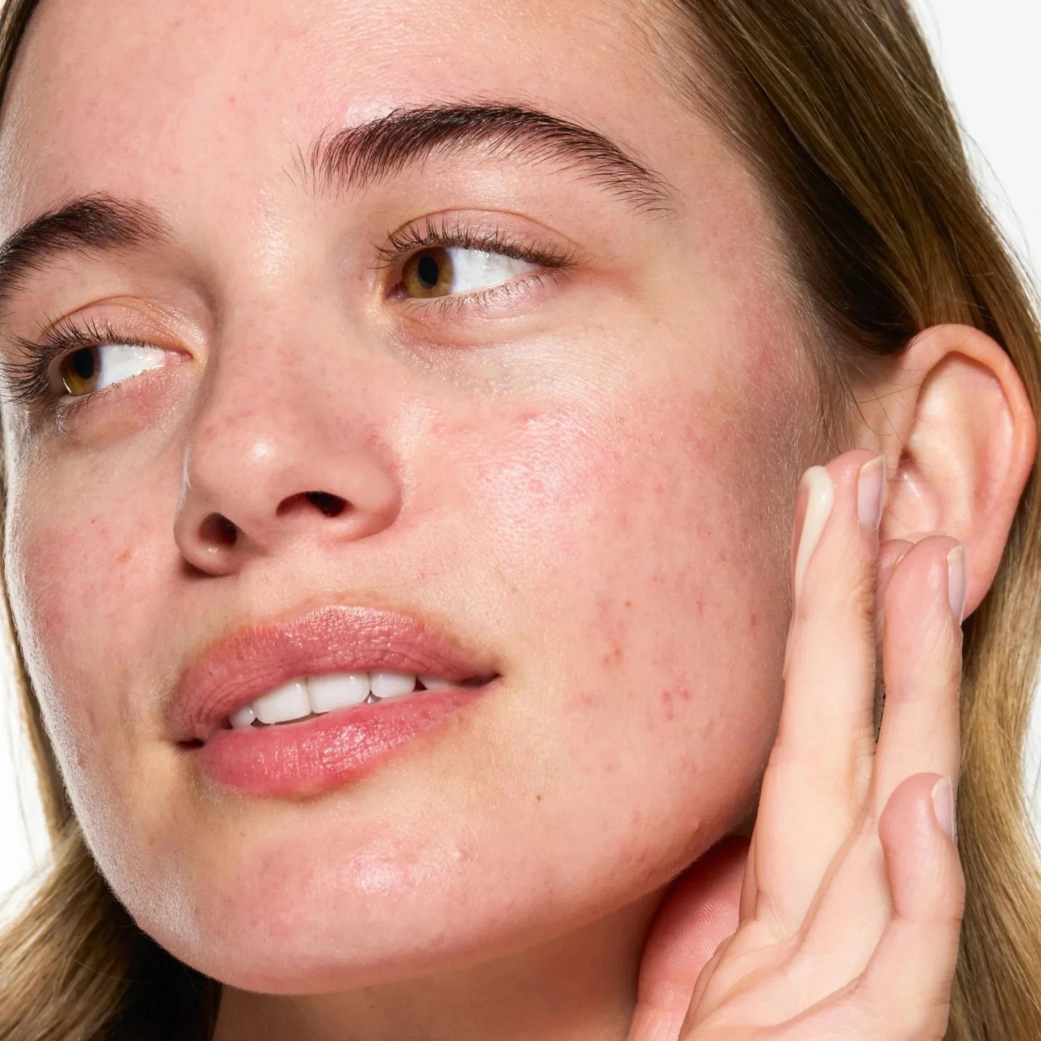 Red Marks and The Hyperpigmentation Serum