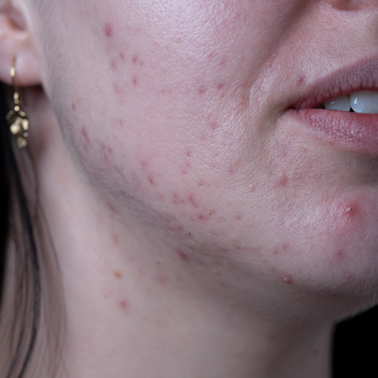 Hormonal Acne 101