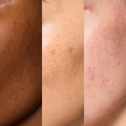 Hyperpigmentation, Dark Marks and Red Marks – How to Spot the Difference