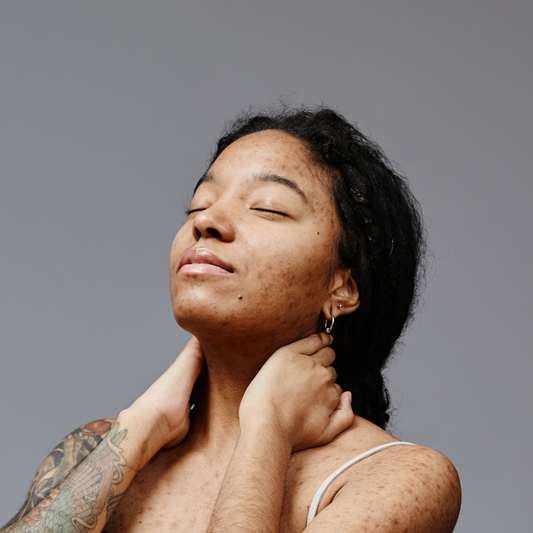 Hyperpigmentation: Your Guide to Prevent and Treat It