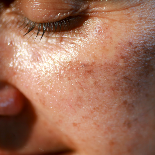 Post Summer Skin Repair: The Protect and Treat Trifecta for Hyperpigmentation and Sun Damage